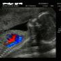 ULTRASONIDO doppler Color
