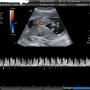 ULTRASONIDO doppler