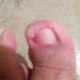 Subido por visitante en 24/09/2015 - Uña encarnada me la intente quitar pero aun ladito me salio un pedacito de carne en forma de globito i me lastima muchoo i me arde