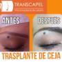 Trasplante cejas