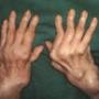 Artritis- Tratamiento Orgánico