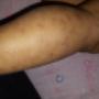 Subido por visitante en 26/10/2017 - Doctor buenas tardes mi hija tiene estos granitod desde que ella tenia 5 meses yo pense que era varicela pero conforme paso el tiempo esto no se le quitaba y pues la verdad ya no se que hacer ya fui con pediatras dermatologos y nadie me ha dicho la verdad y pues estoy desesperada por saber que es porfavor ayudeme