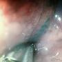 Subido por visitante en 27/10/2016 - Mucosectomia Endoscopica