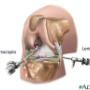 artroscopia de rodilla