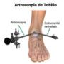 artroscopia de tobillo