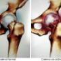 desgaste articular de cadera