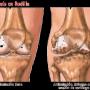 desgaste de la rodilla