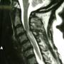 hernia de disco cervical