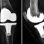 protesis de rodilla