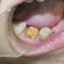 Subido por visitante en 04/09/2017 - preparacion de corona completa para restauracion libre de metal con nun muñon muy pigmentado por la edad