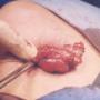 NODULOS EN CUELLO POSTOPERATORIO