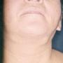 NÓDULOS EN CUELLO