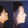 RINOPLASTIA ESTETICA