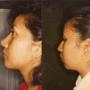 RINOPLASTIA Y MENTOPLASTIA ESTETICA