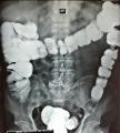 COLON-POR-ENEMA