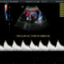 Subido por visitante en 03/08/2016 - Doppler de Arteria Uterina