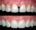 Estética Dental