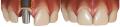 Implantes Dentales