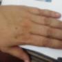 Subido por visitante en 27/06/2018 - Deteccion. De acanthosis nigricans