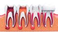 Endodoncia