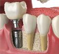 Implante dental