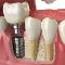 Implante-dental