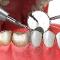 Limpieza-dental-y-radicua