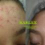 tratamiento control acne