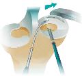 Artroscopia de Rodilla