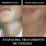 Tratamiento para el vitiligo