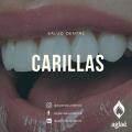 Carillas Dentales