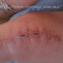 Fisioterapia después de cirugía de rodilla