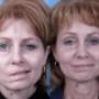 Parálisis facial