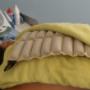Termoterapia