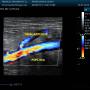 Subido por visitante en 20/01/2018 - DOPPLER ARTERIAL