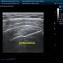 Subido por visitante en 20/01/2018 - ULTRASONIDO DEL MANGUITO ROTADOR, TENDON DEL SUPRAESPINOSO