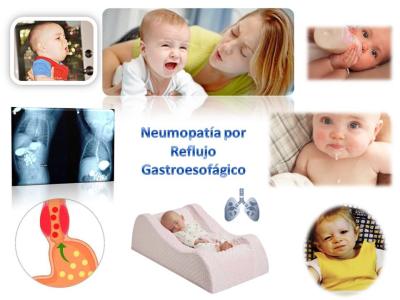 Neumopatía-por-Reflujo-GE