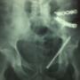 cirugía de pelvis