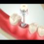IMPLANTES DENTALES