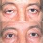 Ptosis