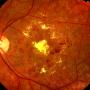 Retinopatía diabética
