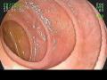 Colonoscopia