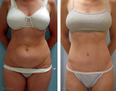 Abdominoplastia