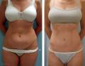 Abdominoplastia