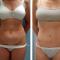 Abdominoplastia