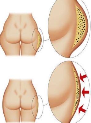 liposucción-de-cadera