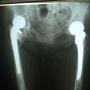 Ambas Caderas
