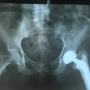 Ap Pelvis