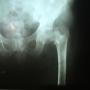 Fractura Cadera