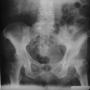 Pelvis